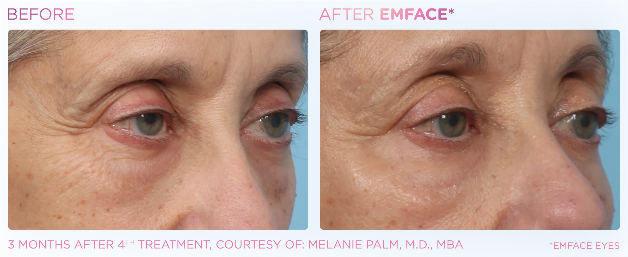 Emface_PIC_Ba-card-female-eyes-178_ENUS100