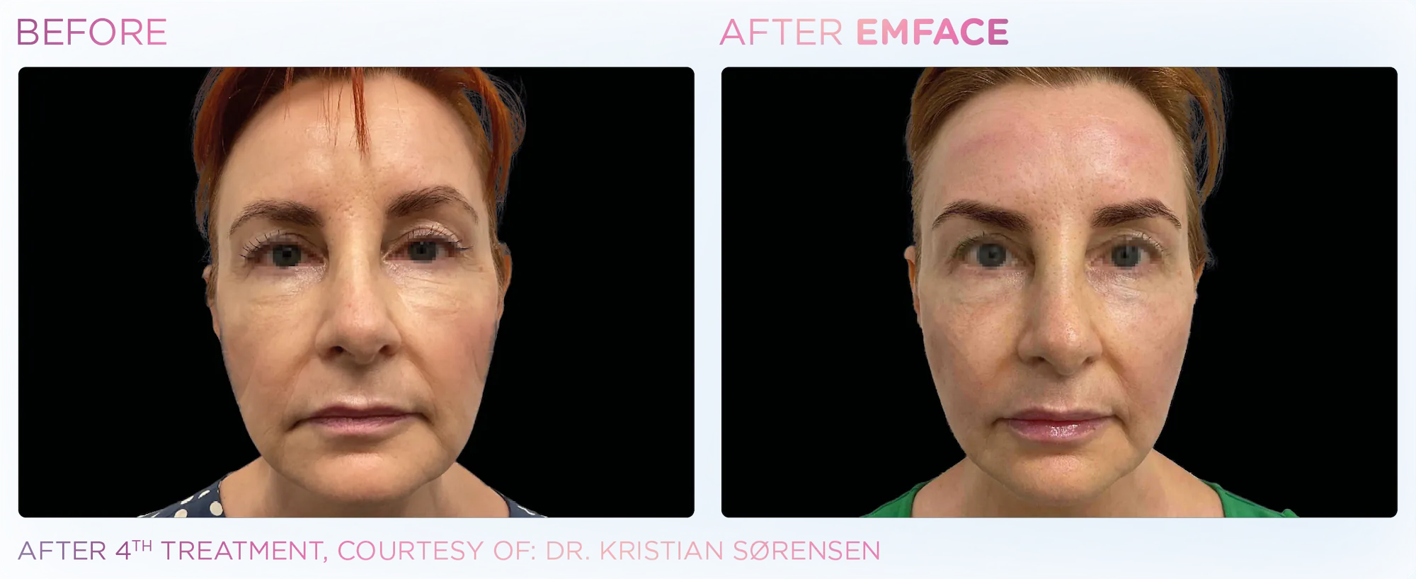 Emface_PIC_Ba-card-female-face-063_ENUS100