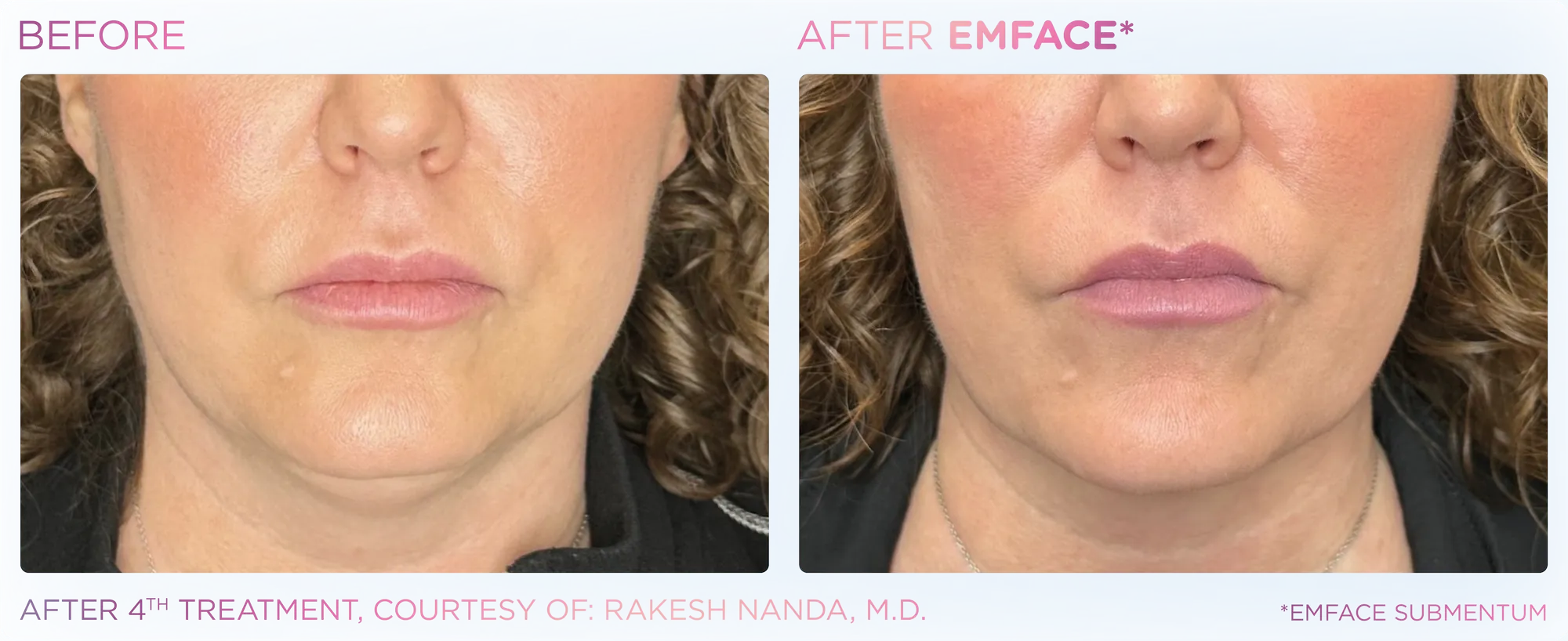 Emface_PIC_Ba-card-female-submentum-126_ENUS100