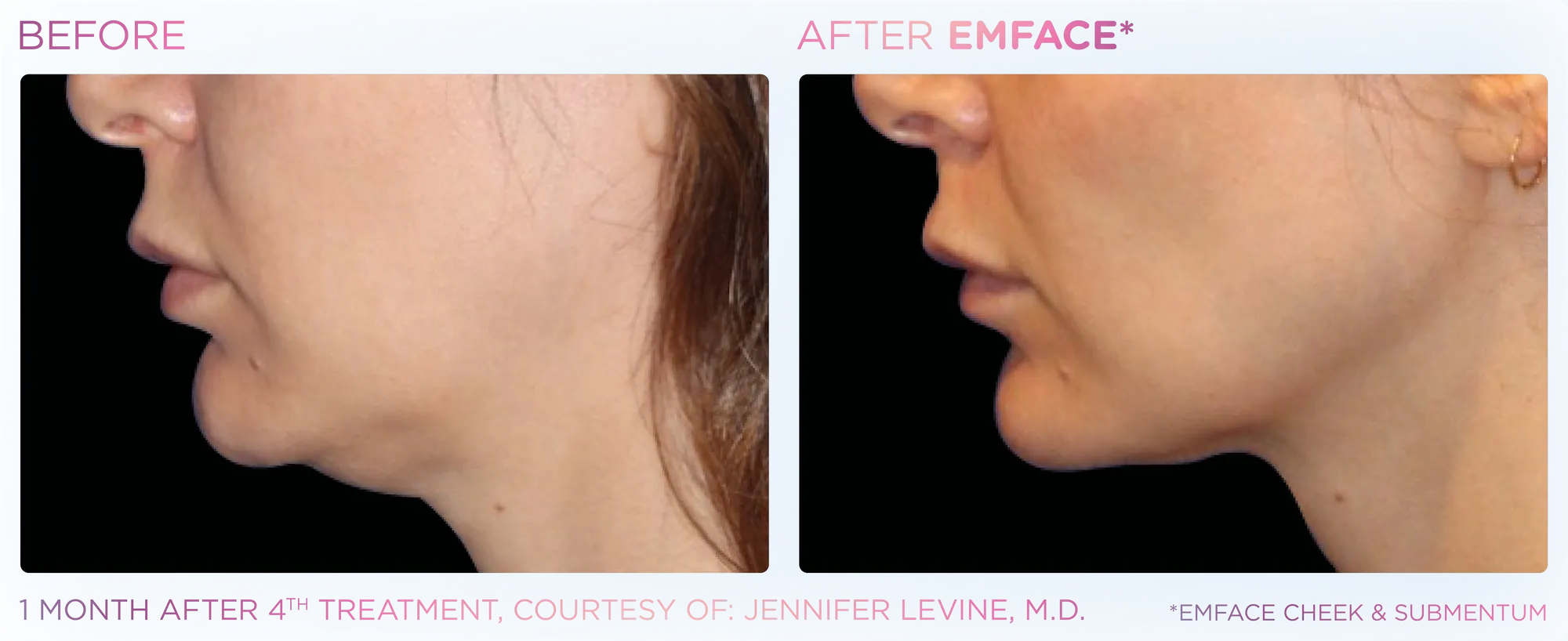 Emface_PIC_Ba-card-female-submentum-cheek-123_ENUS100 (1)