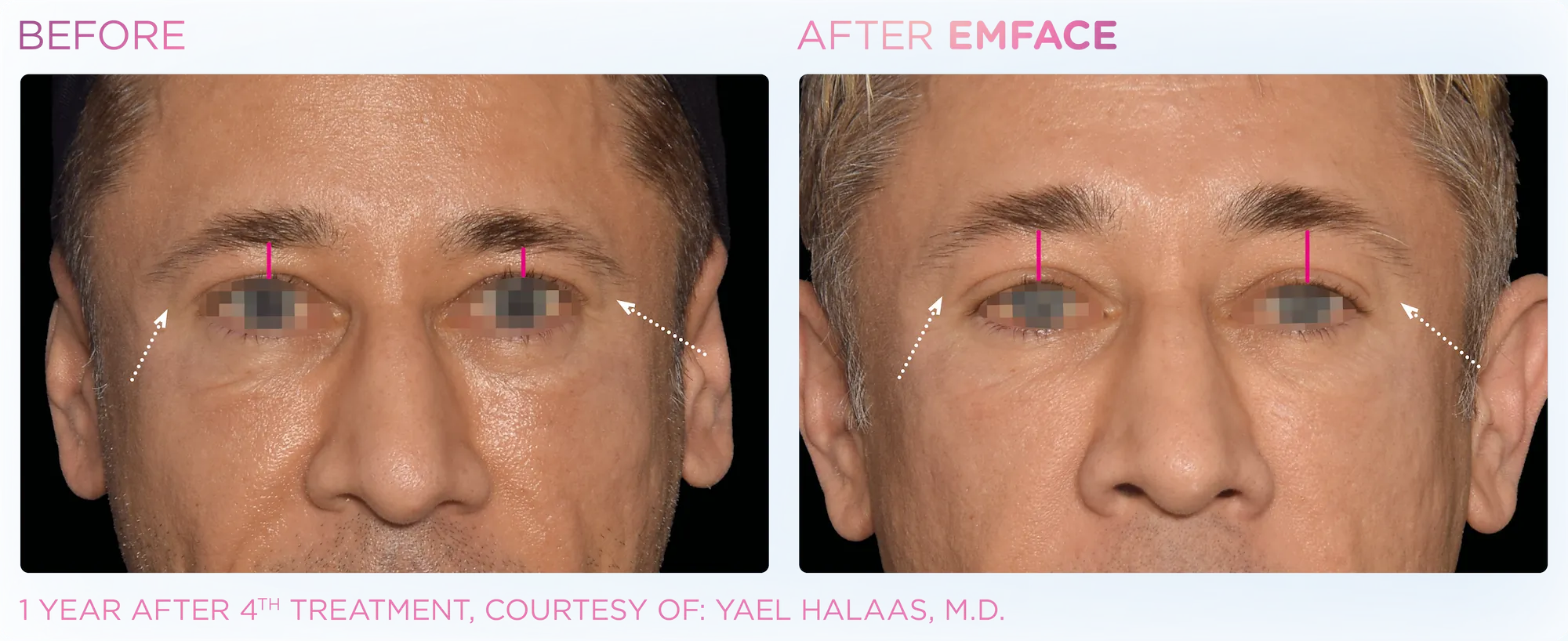 Emface_PIC_Ba-card-male-eyes-130_ENUS100