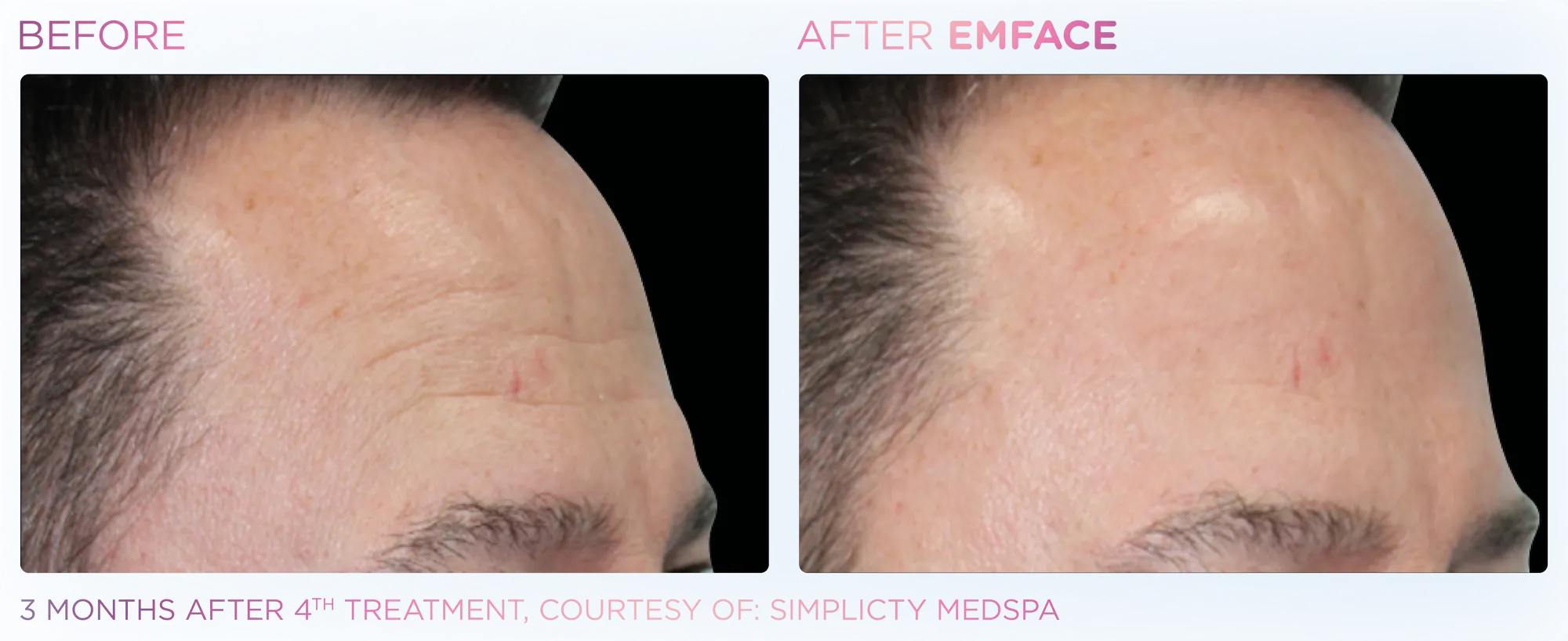 Emface_PIC_Ba-card-male-forehead-085_ENUS100